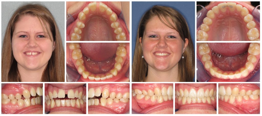 Invisalign (Clear Braces) Las Vegas Henderson NV